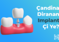Çandina Diranan(Implant) Çi Ye?