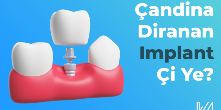Çandina Diranan(Implant) Çi Ye?